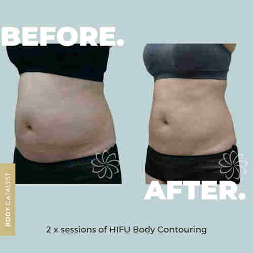 Body contouring treatment Body contouring treatment