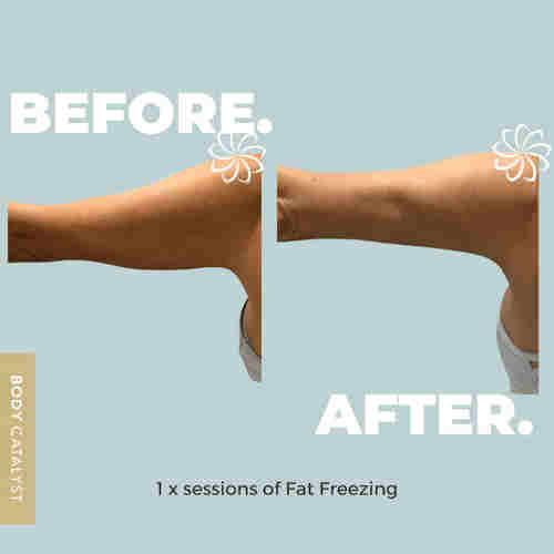 Fat Freezing Treatment Fat Freezing Treatment